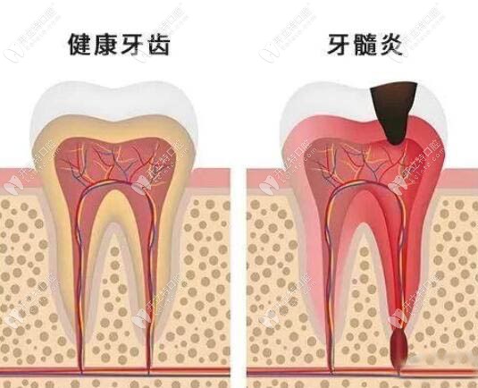 牙疼如何判断是牙髓炎图片