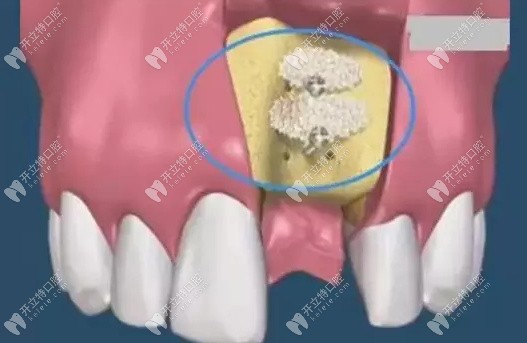 上颌窦提升必须植骨粉吗?那种植牙上颌窦提升多久可以恢复?