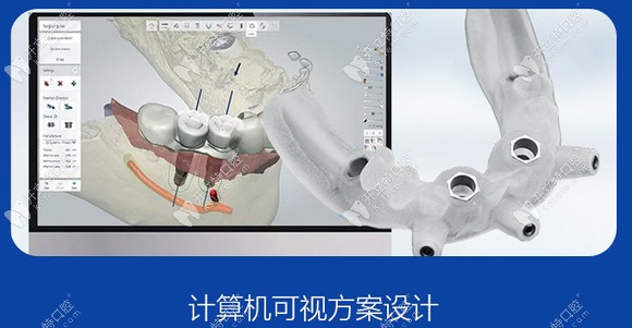 南京润玺口腔的3D导板种植