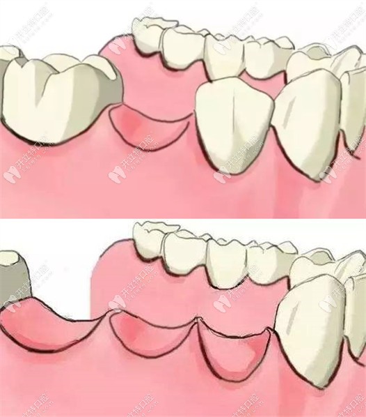单颗牙与多颗牙缺失选择固定义齿还是活动的好