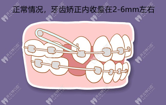 一般牙齿矫正会内收大概在2-6mm