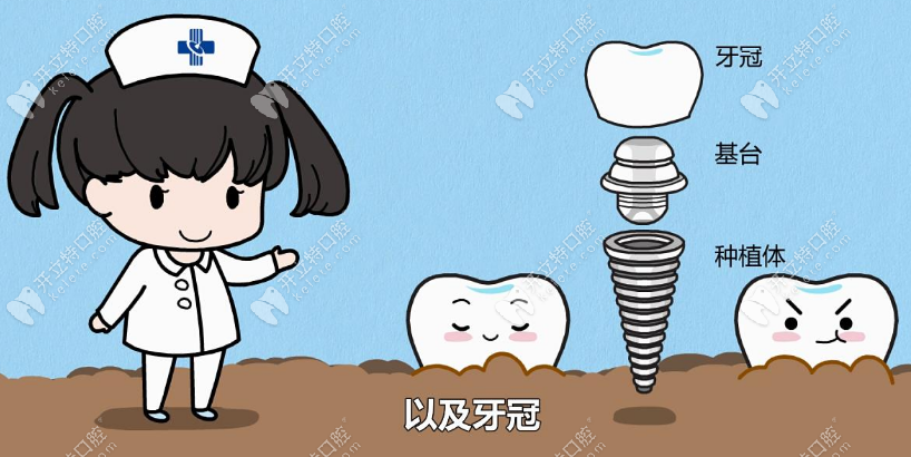 连云港江南口腔种植一颗牙的价格