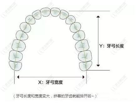 扩弓牙齿矫正