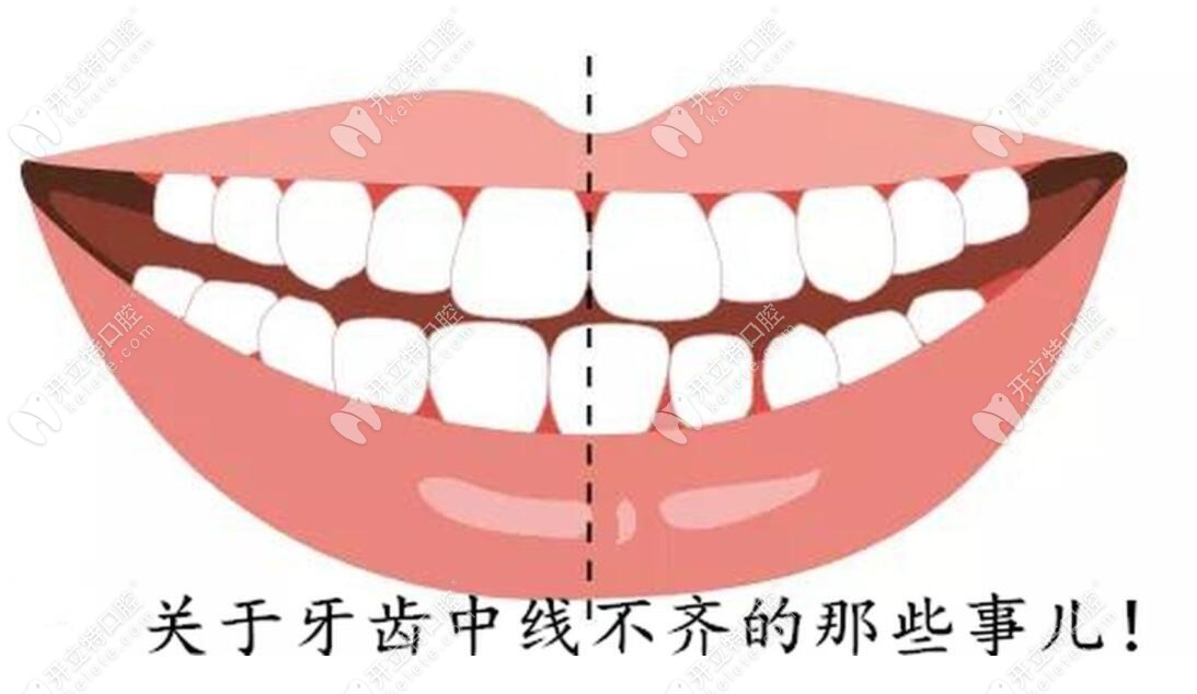 牙齿中线偏移1-2毫米算正常范围之内吗?需要调整不