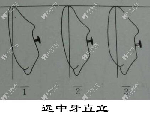 远中牙直立牙齿矫正