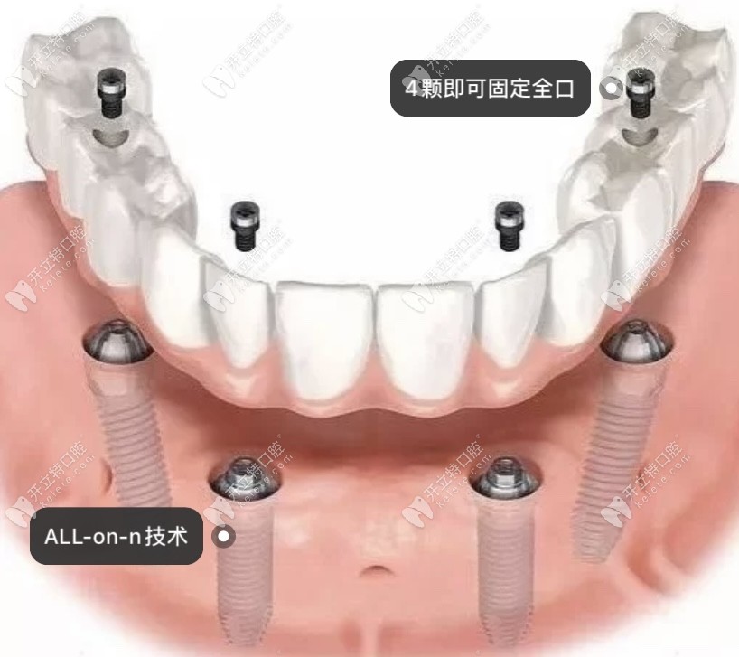 all-on-4种植牙过程示意图