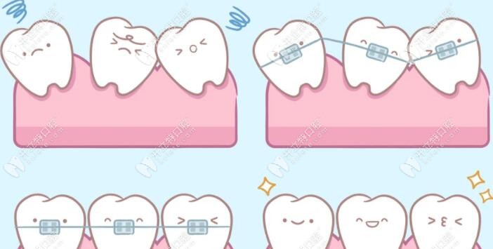 牙齿矫正类型