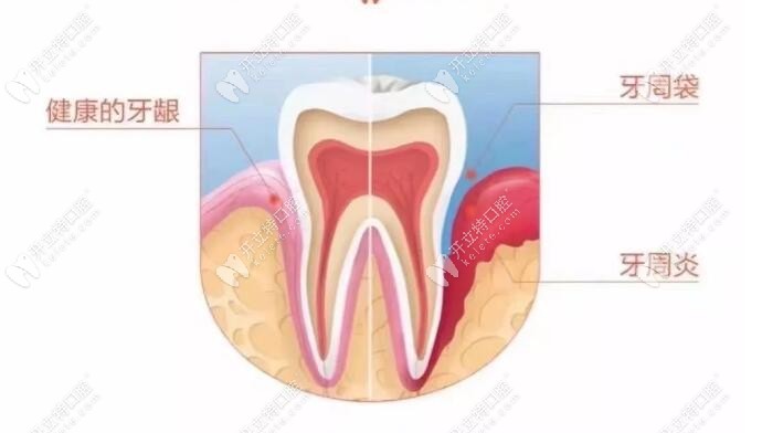 牙周炎和健康牙龈的对比