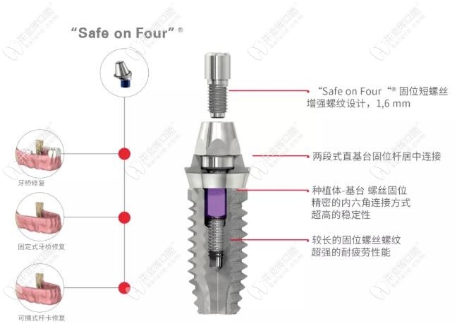 瑞士sic两段式基台可用于半全口种植