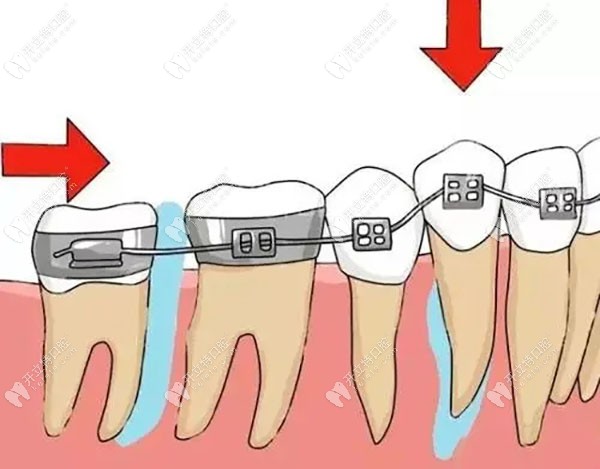 给牙齿一个拉力让牙缝关闭