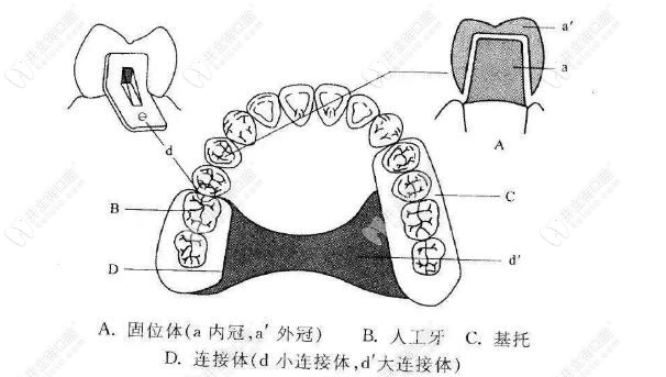 套筒冠义齿的组成