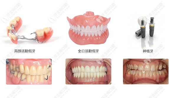 牙齿缺失的几种修复方式