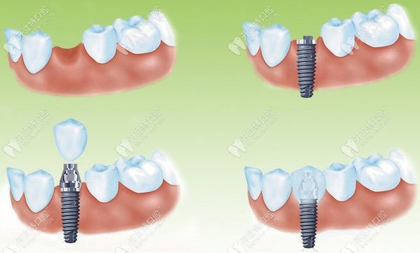 微创种植牙手术过程步骤