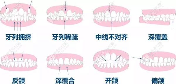 需要矫正的牙齿类型