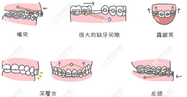 正畸过程设置支抗