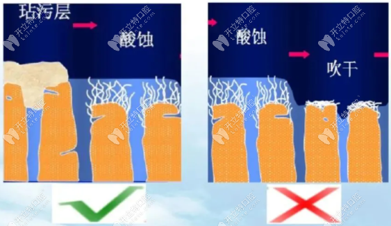 涂布粘接剂前，牙齿表面湿度不当