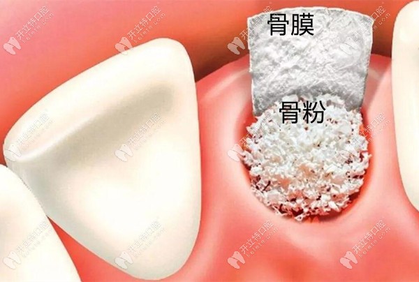 广州穿颧穿翼种植医生冯志强的上颌骨缺失种牙病例展示