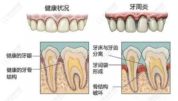 做牙龈刮治后不会导致牙龈萎缩