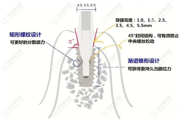 韩国仕诺康种植体是纯钛材质