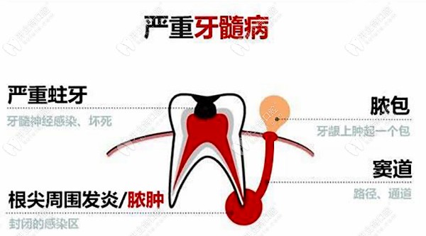 牙龈上长脓包的原因之一