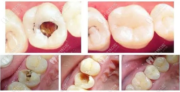 德國樹脂補牙材料比3m好嗎同為樹脂材料補牙後能維持幾年