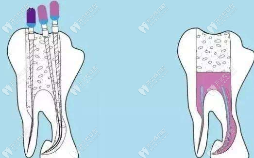 乳牙在什么情况下要做根管治疗