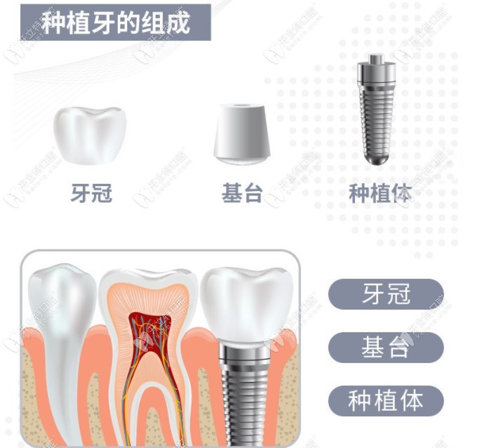 看看种植牙包含哪几部分