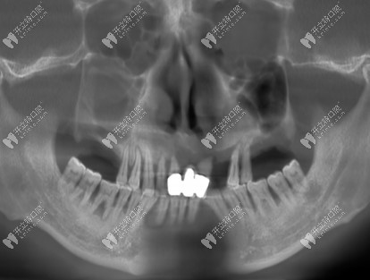 种牙前拍的CT片