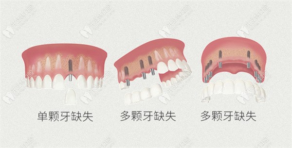 牙齿缺失数目不同方案也不同