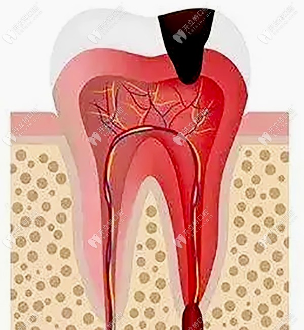 牙齿出现牙髓炎