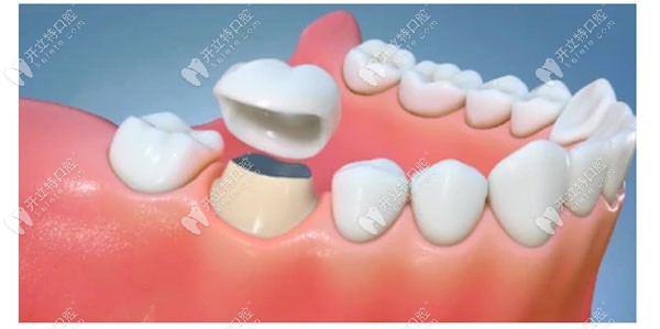活髓牙戴牙冠保护牙体
