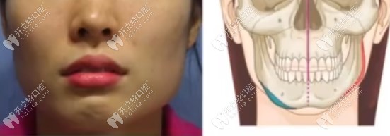 面部形态导致的脸一大一小
