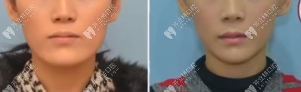 这个地包天小姐姐就是实例，刚开始只做了下颌角手术