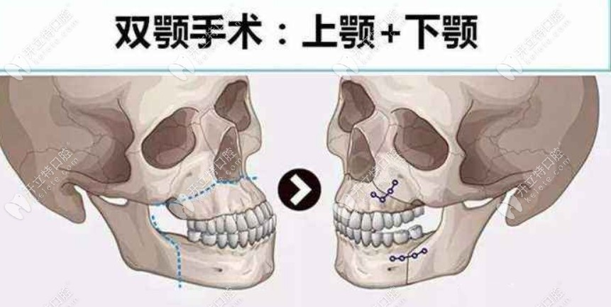 正颌手术是不是很受罪