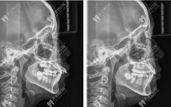 前牙外突治療之后的影響片