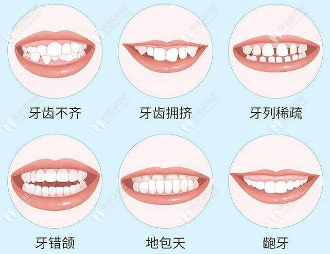 牙齿畸形图