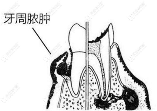 牙龈脓肿怎么办呢