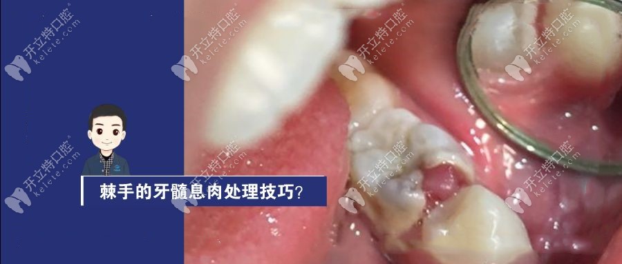 牙髓息肉在一般诊所可以做吗