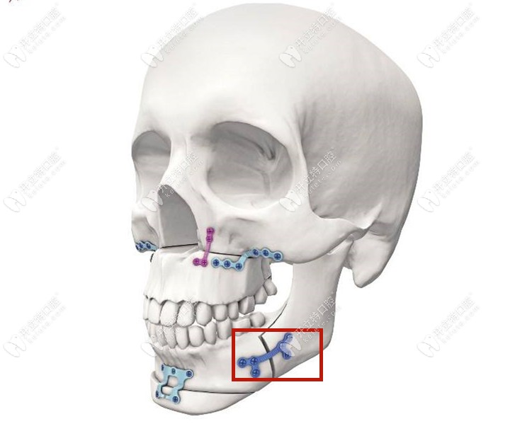 做正颌手术进口钛板和国产钛板的区别