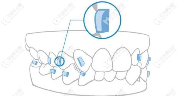 隐形牙套中的附件位置