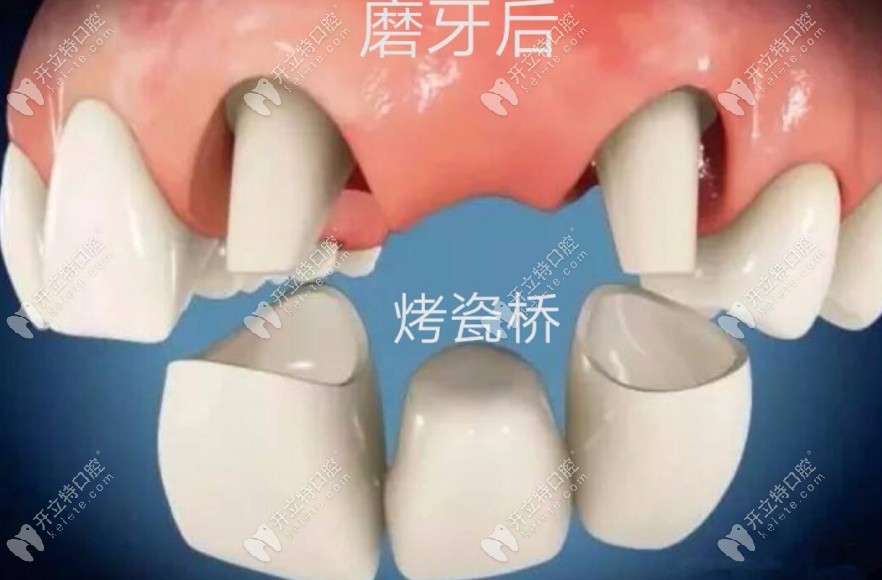 烤瓷牙修复缺失牙齿的方法