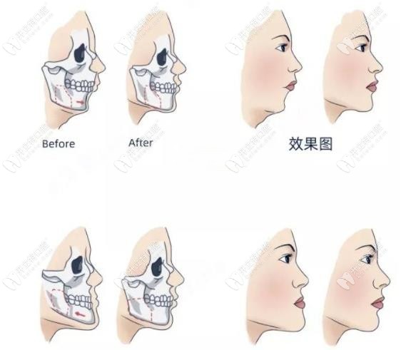 正颌手术竟对鼻子有影响?网友都说正颌手术后鼻翼变宽了
