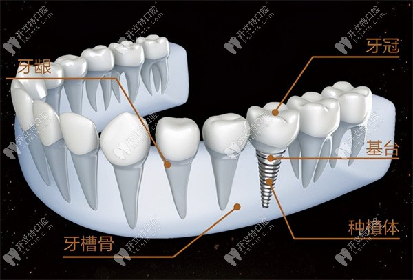 种植牙为什么这么贵