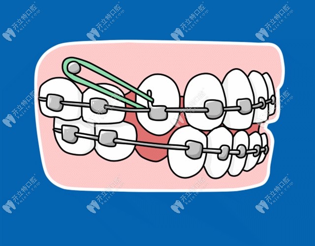 牙齿矫正过程图示