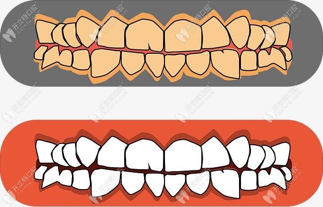 牙齿外凸龅牙矫正图