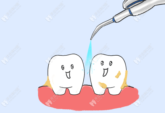 洗牙是去除龈上菌斑和牙石