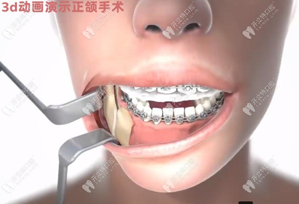 3d动画演示正颌手术改善地包天、龅牙、凸嘴的完整过程