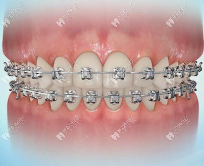 牙齿矫正期间怎么保持口腔卫生