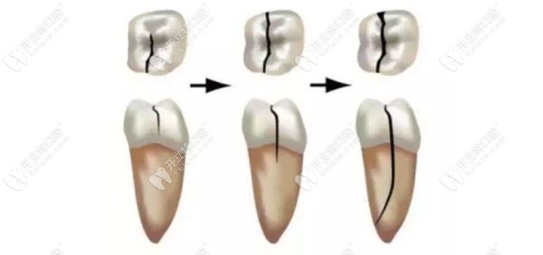 牙隐裂的治疗方法