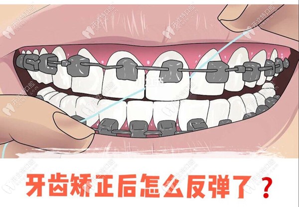 牙齿矫正反弹一定要重新整牙吗?正畸反弹的补救办法快掌握